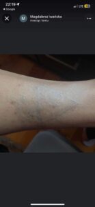 usuwanie tatuazu olsztyn