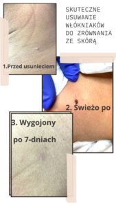 Usuwanie włókniaków, brodawek, kurzajek laserem ablacyjnym CO2
